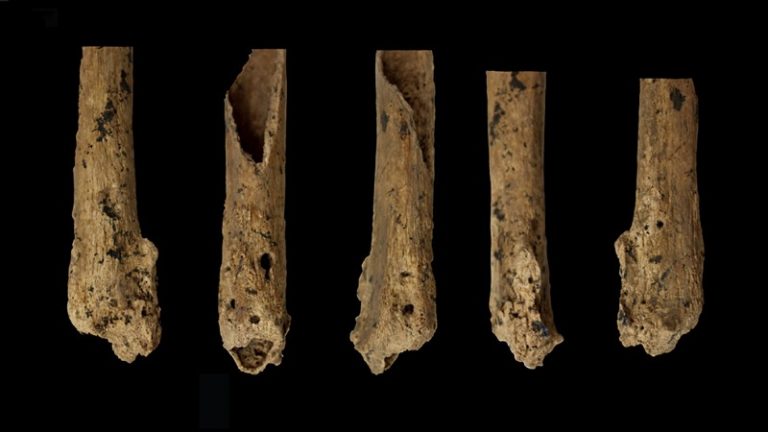 Prehistoric child’s amputation is oldest surgery of its kind
