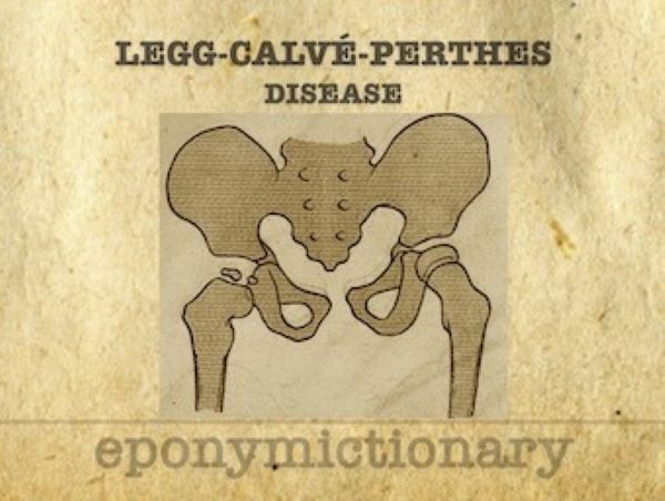 Legg-Calvé-Perthes-disease-340