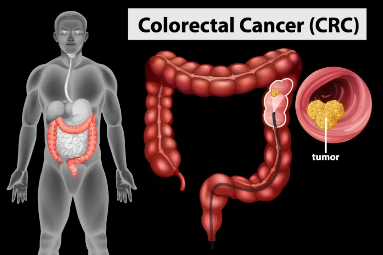 Colorectal Cancer: A new Threat to Young Adults